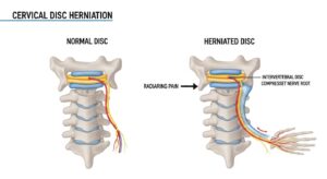 목디스크 자가진단